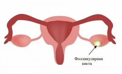 Кия слева гинекология что это?